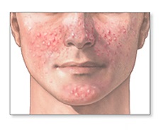 acne (1)